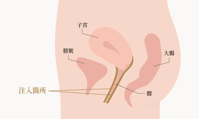 名器形成(膣ヒアルロン酸)の注入箇所の図解